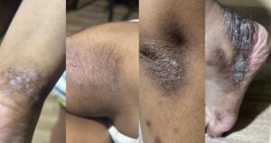 އެކްޒަމާގެ ސަބަބުން ސާރާގެ ހަށިގަނޑުގެ އެކި ހިސާބުތަކައް ލިބިފައިވާ ގެއްލުން